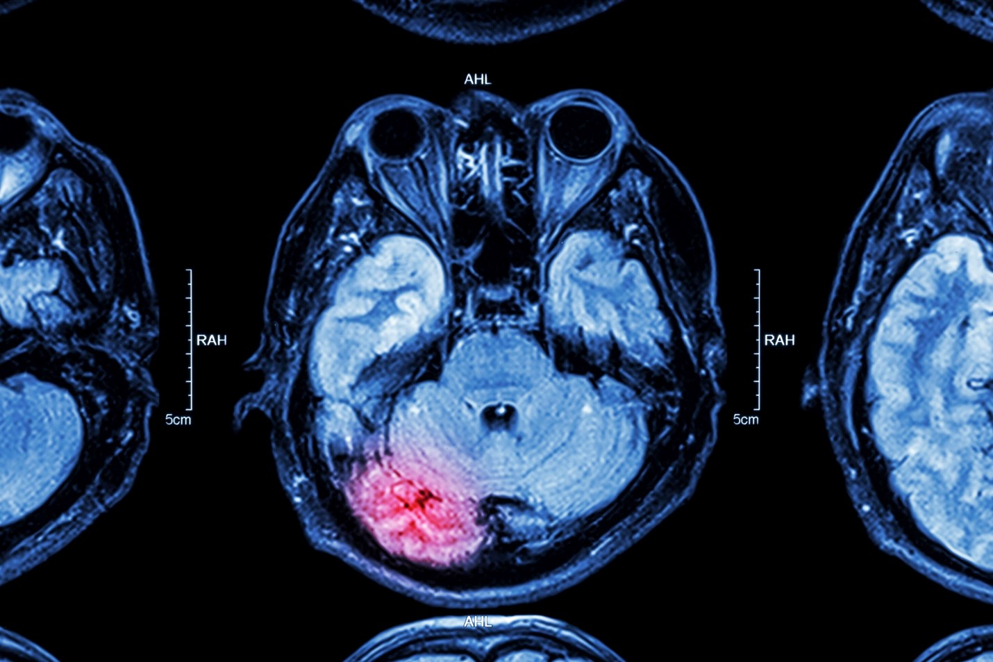 Bicycle Safety for National Brain Injury Awareness Month